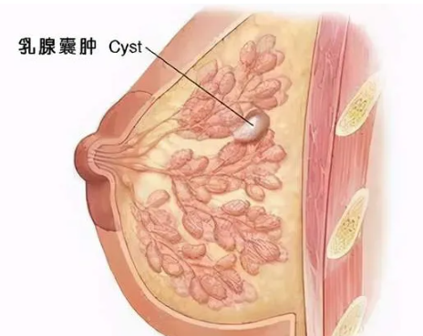 【乳腺囊肿怎么治】乳腺囊肿的治疗方法