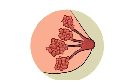 乳腺增生