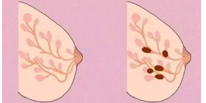 乳腺增生结节3类怎么治疗
