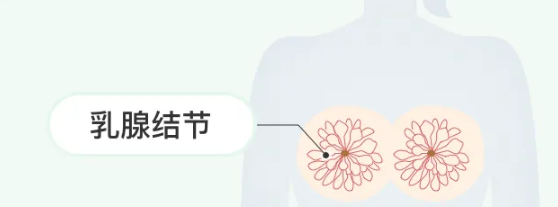 乳腺结节消除