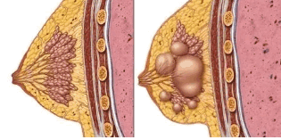 乳腺结节3类严重吗